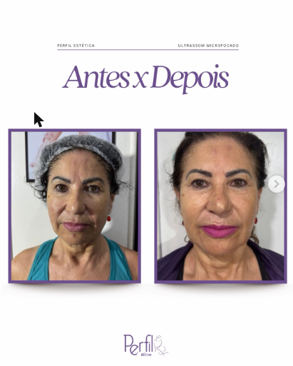 Resultado antes e depois de tratamento facial na Perfil Estética