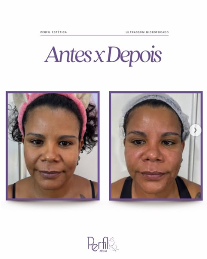 Resultado antes e depois de tratamento facial na Perfil Estética