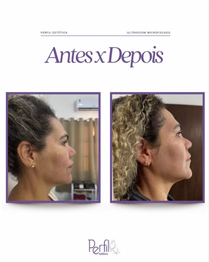 Resultado antes e depois de tratamento facial na Perfil Estética, perfil lateral